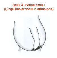 Perine fistülü (Çizgili kaslar fistülün arkasında)
