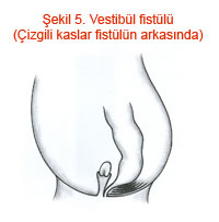 Vestibül fistülü (Çizgili kaslar fistülün arkasında)