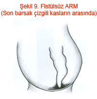 Fistülsüz ARM (Son barsak çizgili kasların arasında)